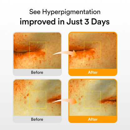 Abib - Glutathiosome Dark Spot Serum Vita Drop 50Ml | CLINICALLY PROVEN to BRIGHTEN HYPERPIGMENTATION in 3 DAYS, KOREAN SKINCARE
